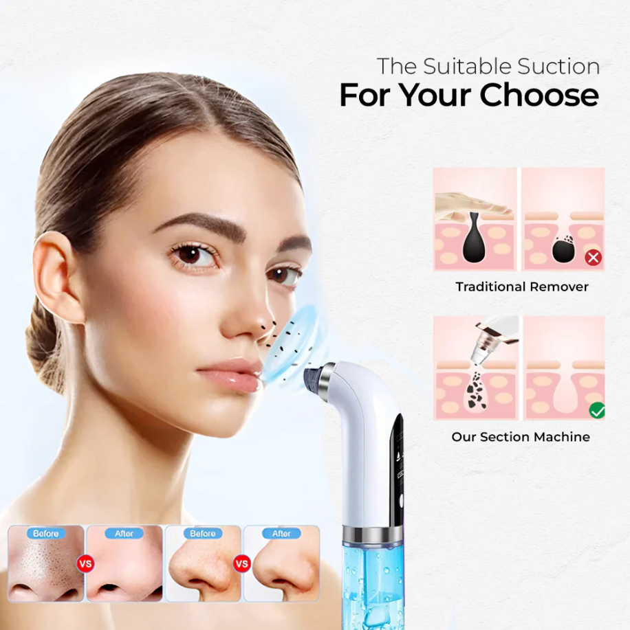 Vacuum Pore Cleaner – 6-in-1 Blackhead Remover